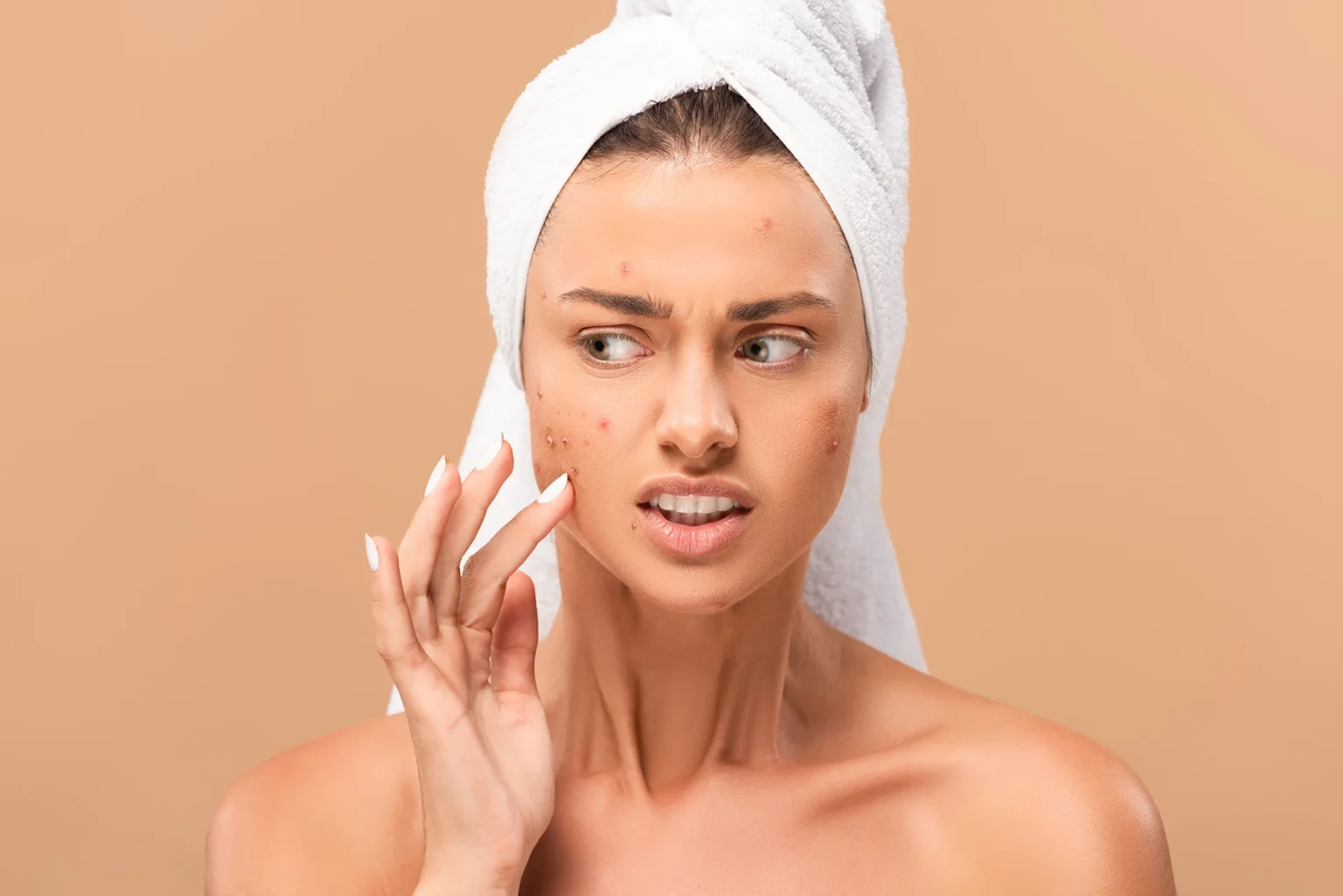 Voeding en acne, wat klopt nu echt?
